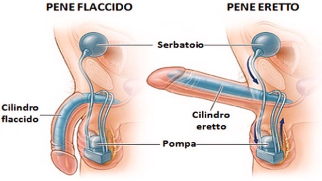 medicina-online-dott-emilio-alessio-loiacono-medico-chirurgo-roma-come-fatta-protesi-peniena-idraulica-tri-riabilitazione-nutrizionista-infrarossi-accompagno-commissioni-cavitazione-radi.jpg