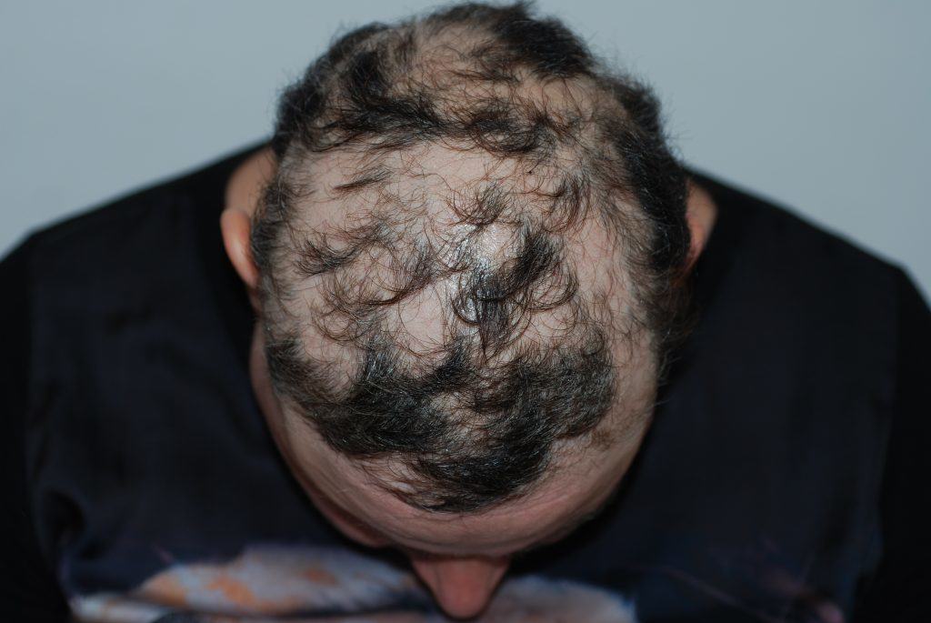 alopecia-areata-6-1024x685.jpg