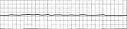 180px-EKG_Asystole.jpg